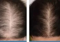 Hair Scalp Rejuvenation with PRF