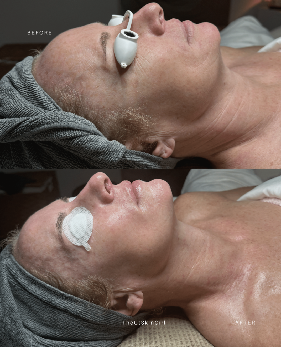 Comparison of a woman before and after a facial treatment. The 'before' shows her with a skin care device on her face, while the 'after' shows her with smooth, refreshed skin and a small patch on her cheek.