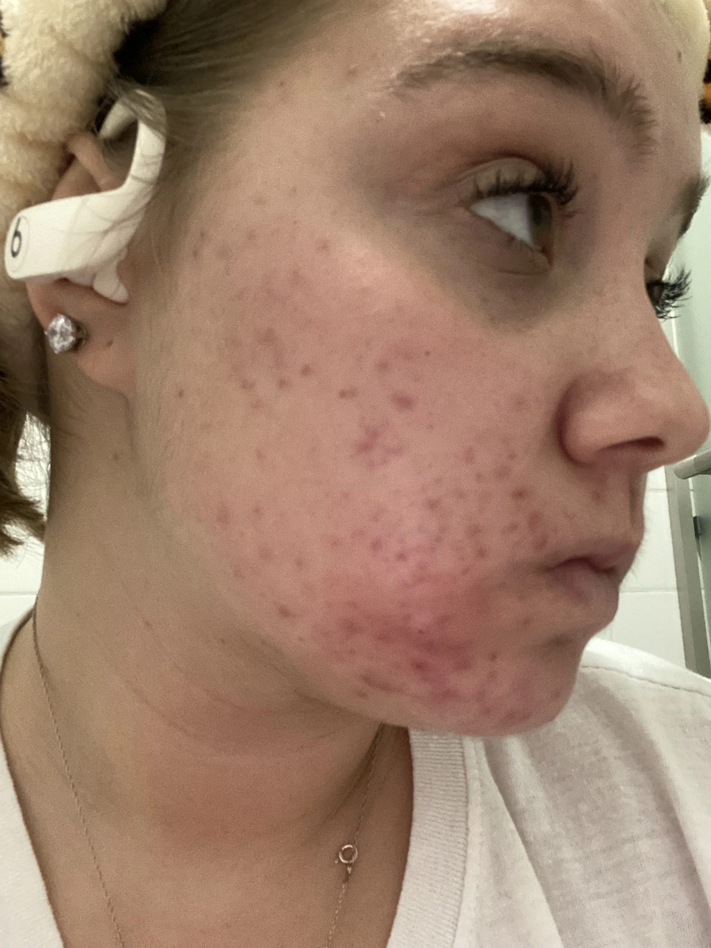 Close-up of a young woman with acne on her cheek, wearing a white shirt, a necklace, and earrings, lying down with her head on a pillow.