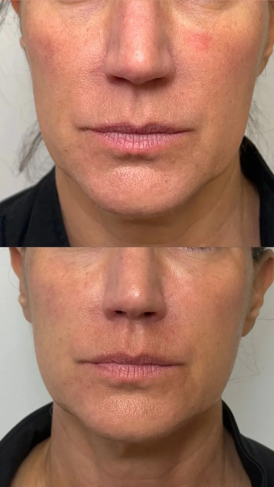Close-up of a person's face showing a before-and-after comparison of skin condition, with the top image displaying red patches and the bottom image showing clearer skin.