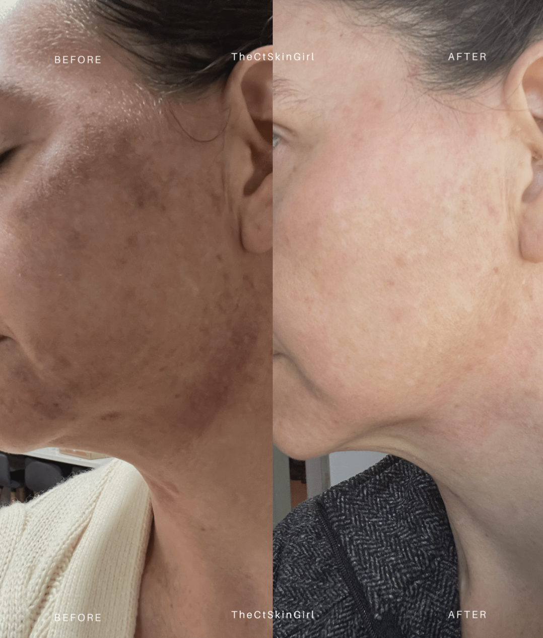 Side-by-side comparison of a woman's face showing skin improvement. The left side is labeled 'Before,' with dark spots and uneven skin texture. The right side is labeled 'After,' with clearer, smoother skin.