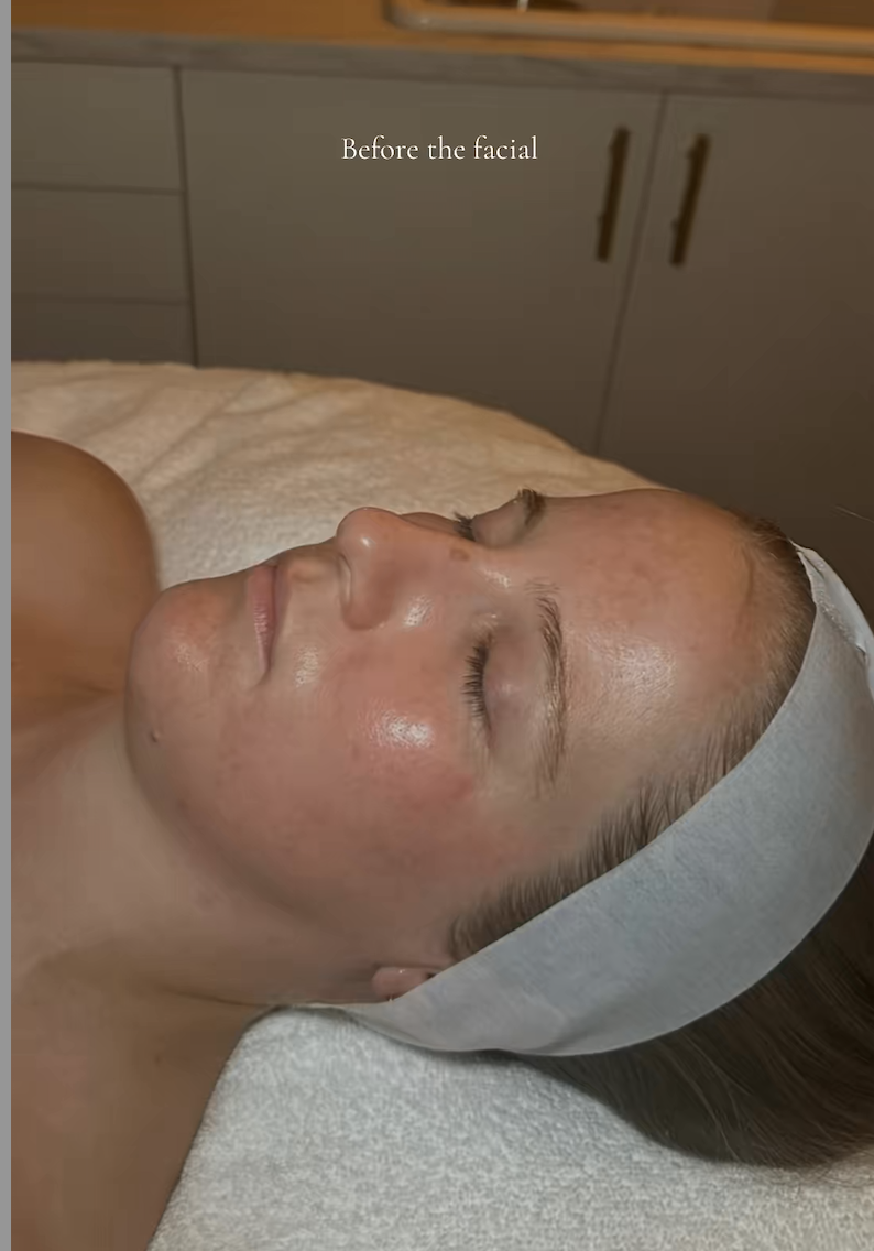 A woman lying on a treatment bed with a white headband, about to undergo a facial treatment in a spa or medical clinic. The background shows gray cabinets and a countertop. The text on the image reads "Before the facial."