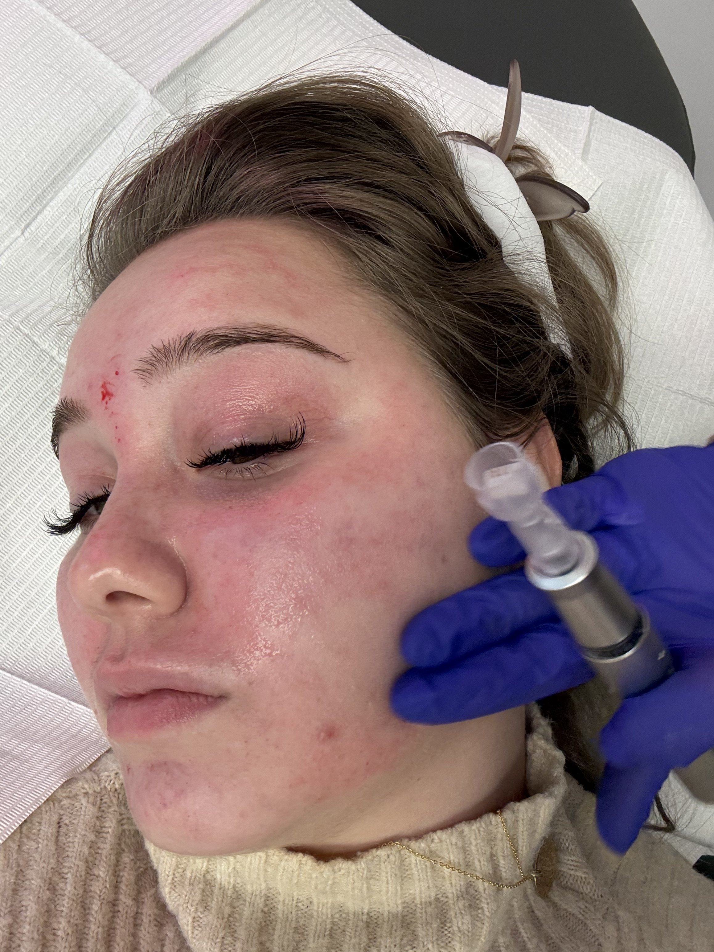 A woman with light skin and brown hair has a needle inserted into her face, likely undergoing a cosmetic or medical procedure, with a gloved hand holding the syringe close to her face.