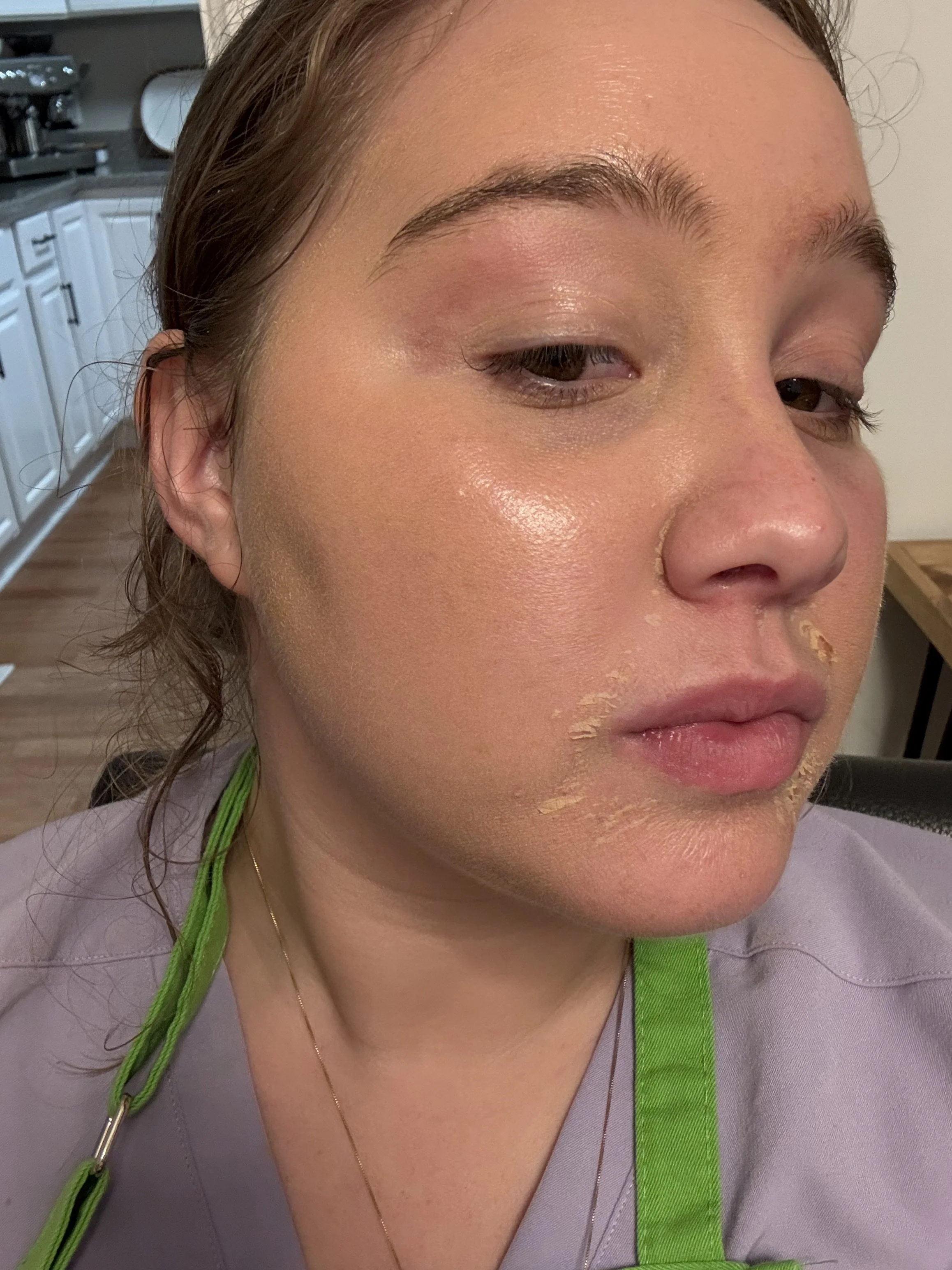 Close-up of a young woman with light brown hair and fair skin, wearing a green apron, with some peeling skin on her face, mainly on her cheek and chin, in a kitchen setting.