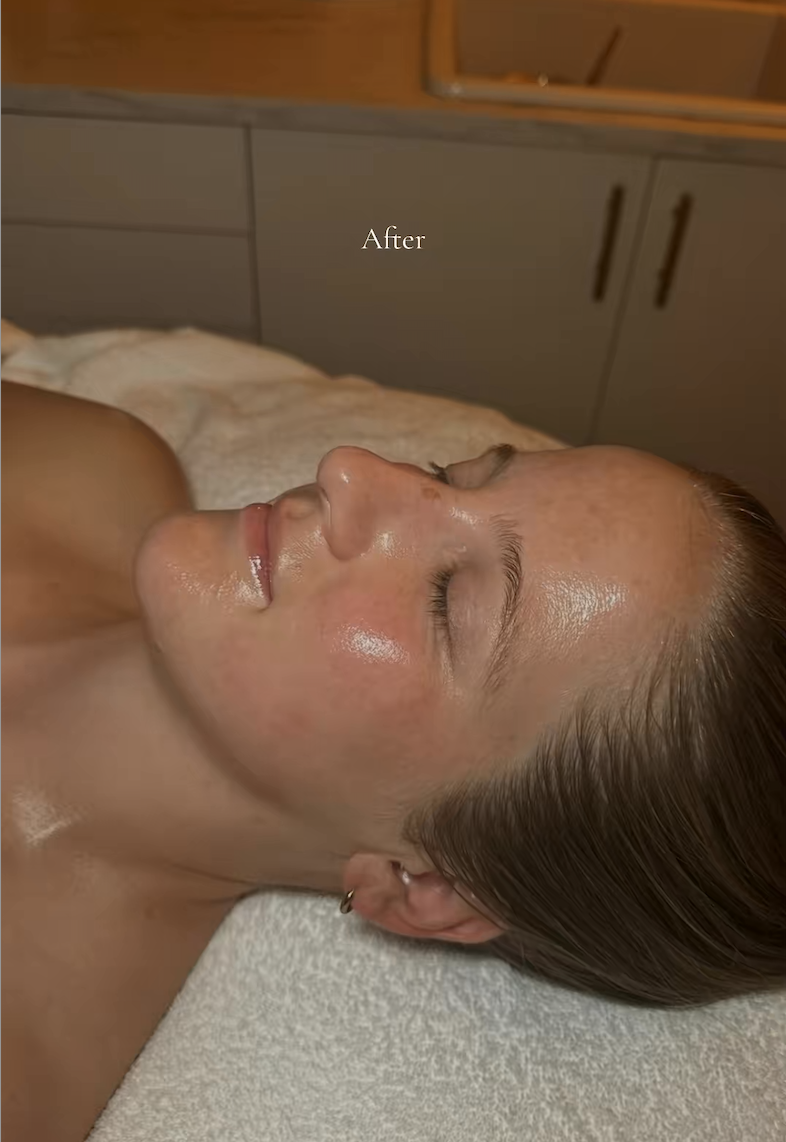 Close-up of a woman lying on a spa bed with closed eyes, receiving a skincare treatment; her skin appears refreshed and moisturized; the background shows a medical or spa office setting with cabinets and a mirror; the word "After" is visible.