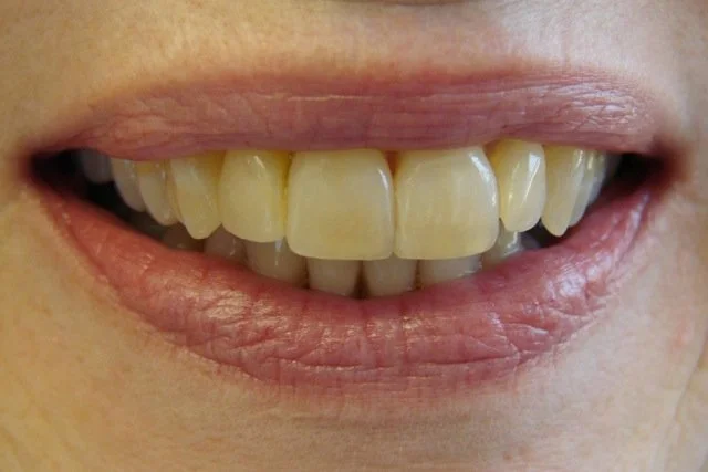 Close-up of a person's mouth showing upper and lower teeth, with some yellowing and minor misalignment.