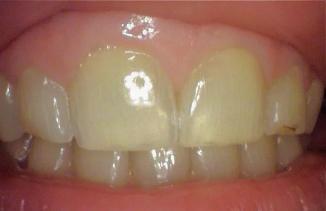 Close-up of front upper and lower teeth, showing discoloration and uneven edges.