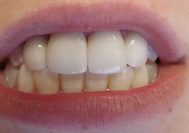 Close-up of a person's mouth showing upper front teeth and lower teeth, with the upper front teeth appearing to have dental crowns or veneers.