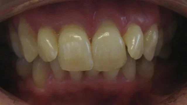 Close-up of misaligned and discolored upper front teeth.