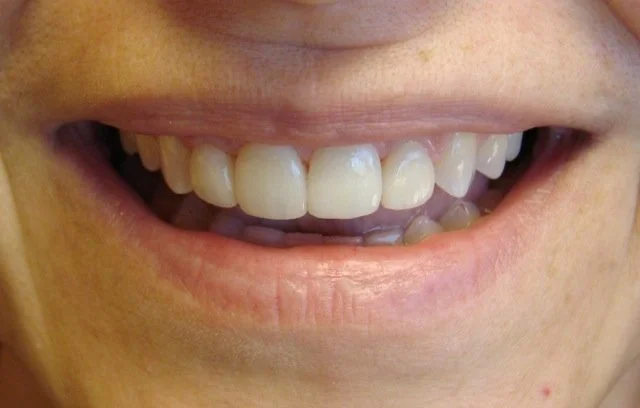 Close-up of a person's smiling mouth showing upper and lower teeth.