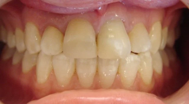 Close-up of a person's teeth showing misalignment and crowding.
