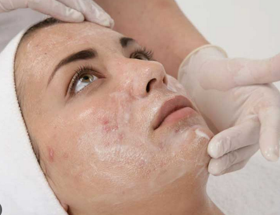 What Does a Chemical Peel Do for Your Skin?