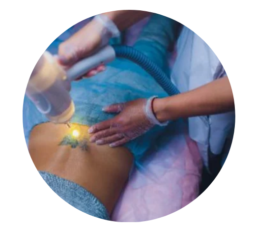 What You Need to Know About Pico Laser Tattoo Removal