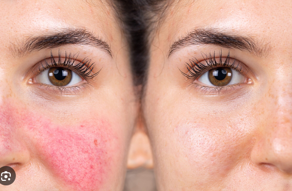Can CO₂ Laser and Vascular Laser Treat Rosacea?