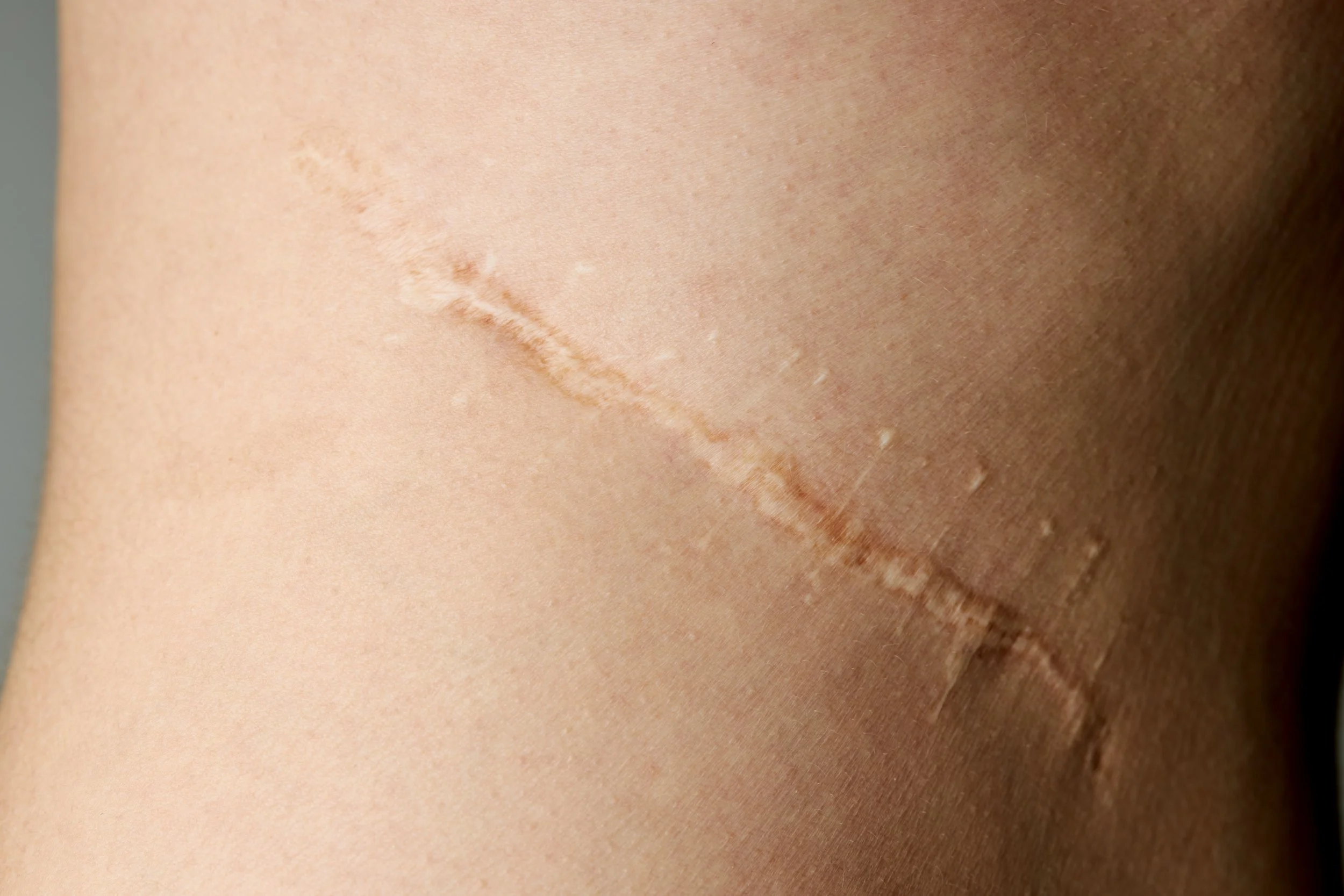 surgical or injury scars