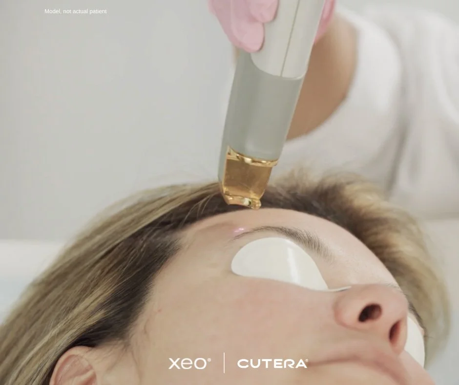 A person receiving a cosmetic treatment on their forehead using a device with a gold-colored tip, wearing eye protection, with a medical professional administering the treatment.