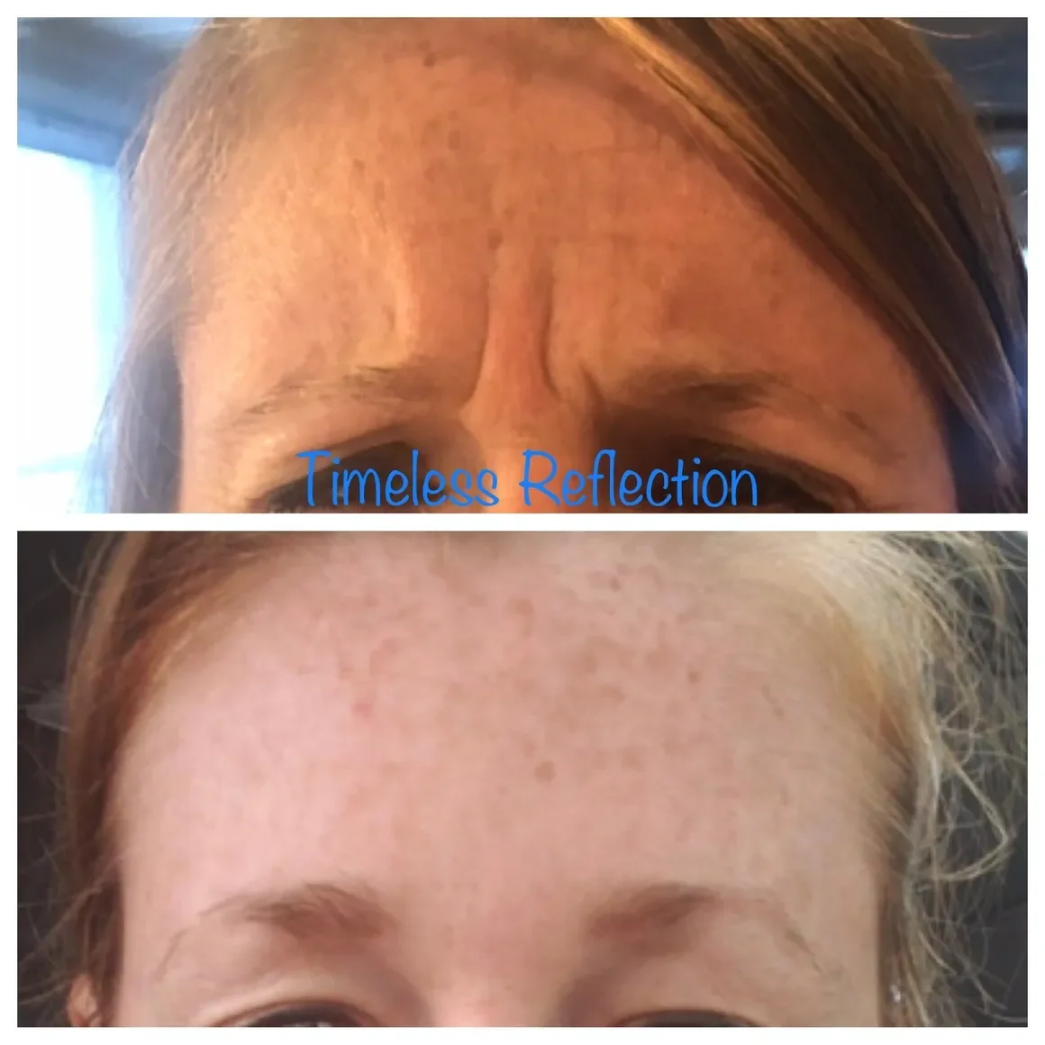 Medspa in Cornelius, NC, 28031 | Before and After 56.webp