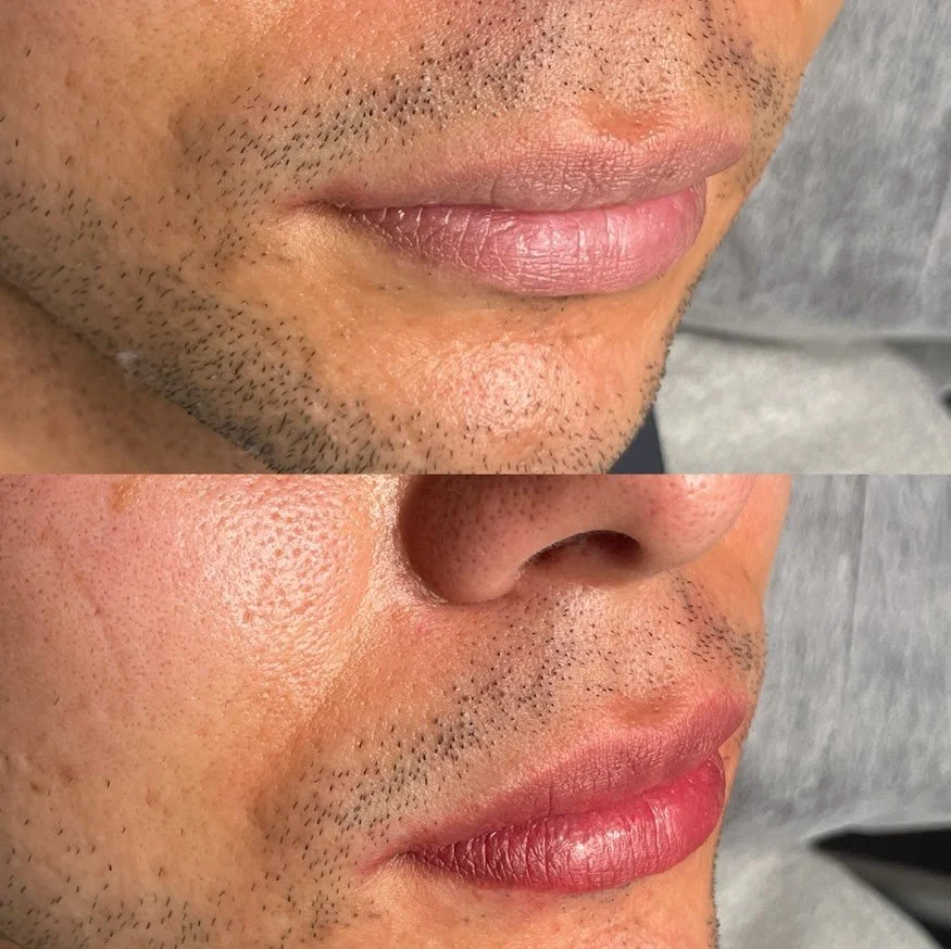 Comparison of a man's lower face before and after cosmetic treatment; the after photo shows smoother skin and more defined lips.
