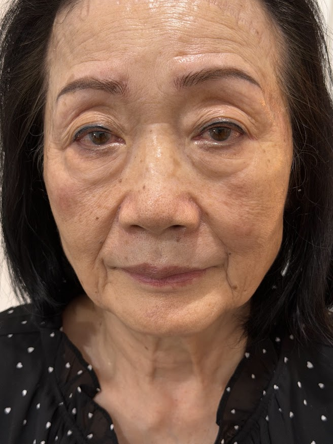 Close-up of an older woman with dark hair, showing signs of aging such as wrinkles and sagging skin, wearing a black top with small white polka dots.