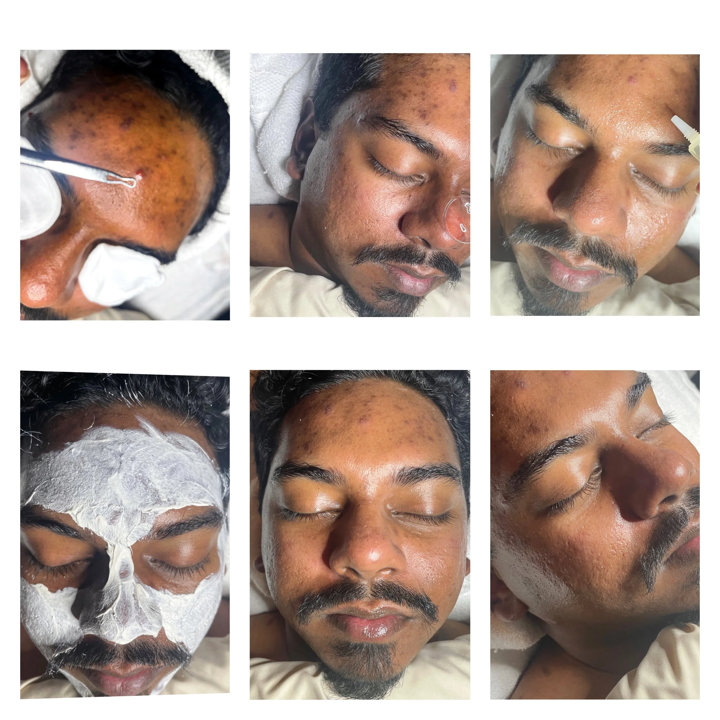 Acne Treatment Facial