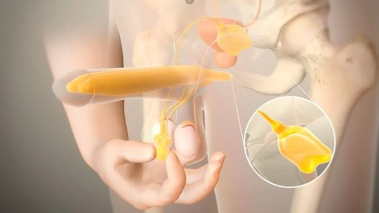 Protesis hidráulica o inflable para implantes peneanos. Cirugía con el Dr. Enrique Fes en Ibiza