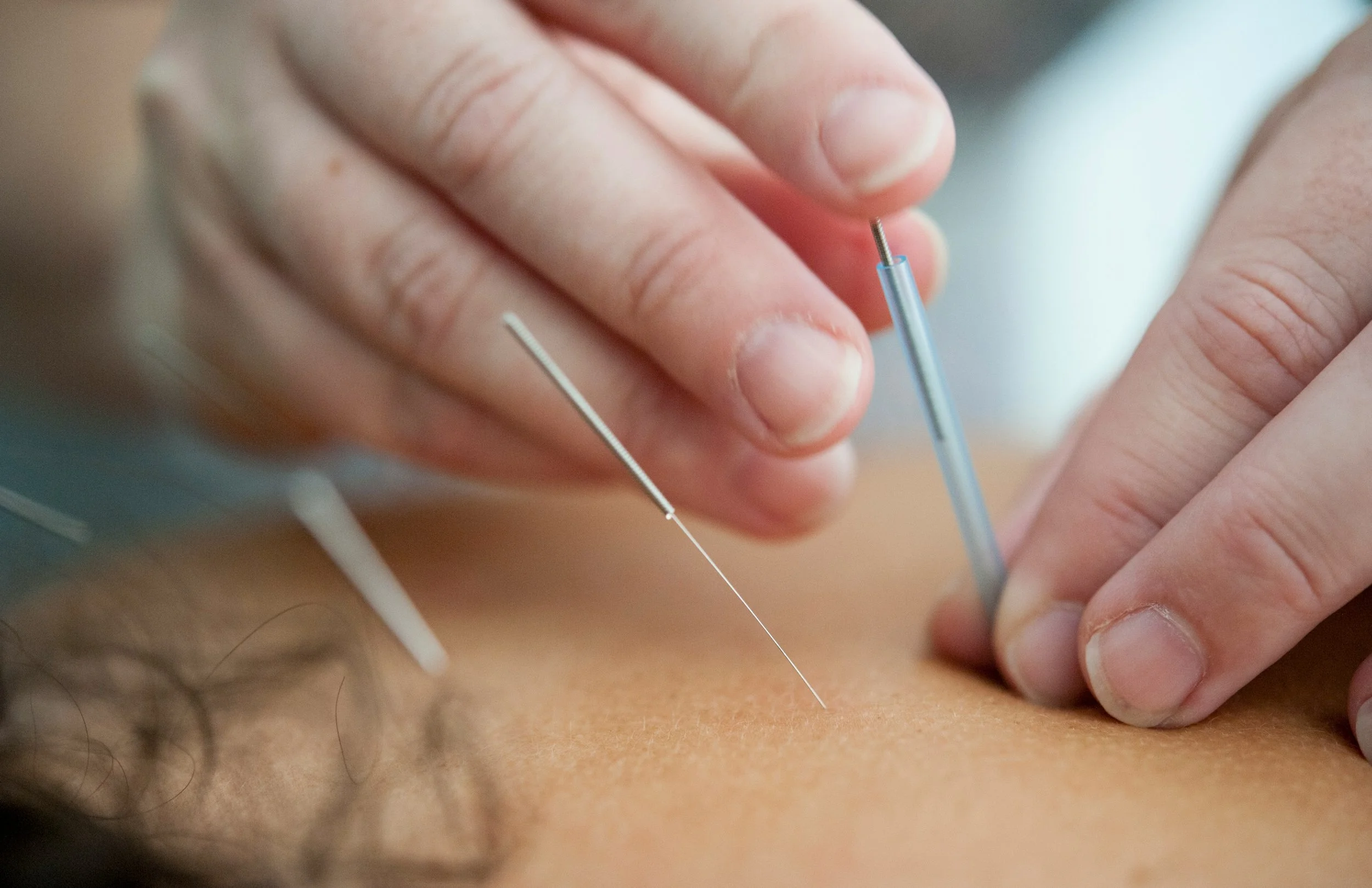 A person receiving an acupuncture treatment with thin needles inserted into their skin.