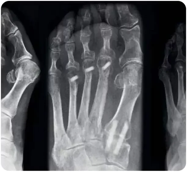 X-ray image of a human hand showing bones and joints.