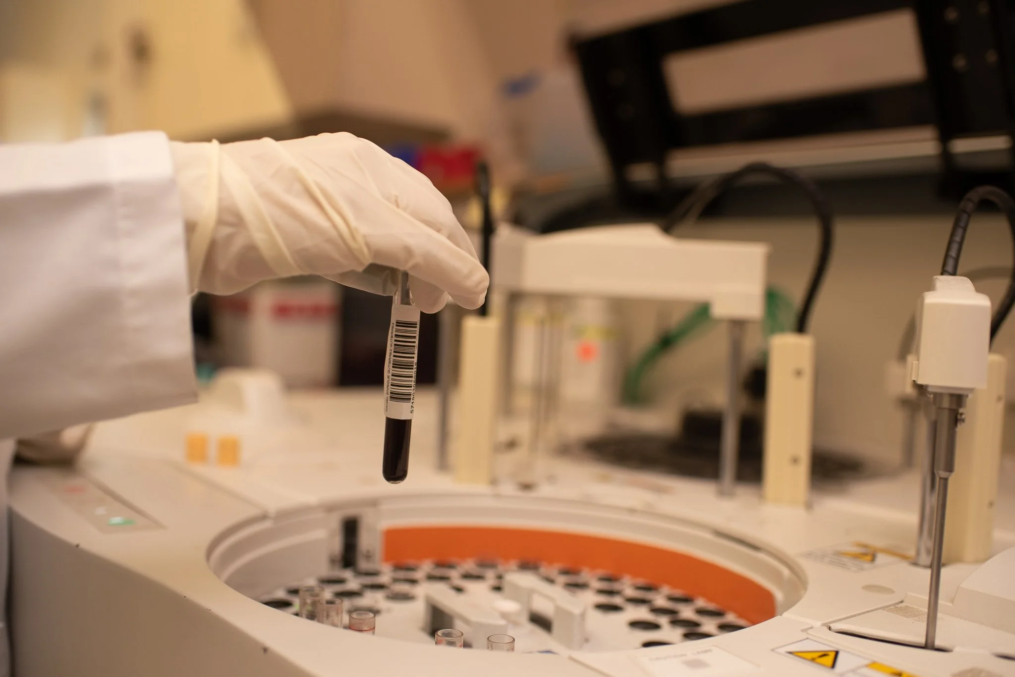 Análisis de Antígeno Prostático Total (PSA) en Mérida