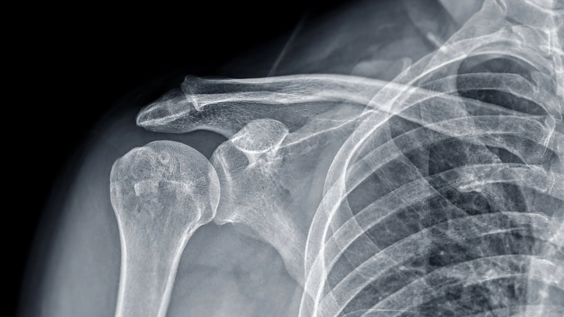 Rayos X de escápula en Mérida