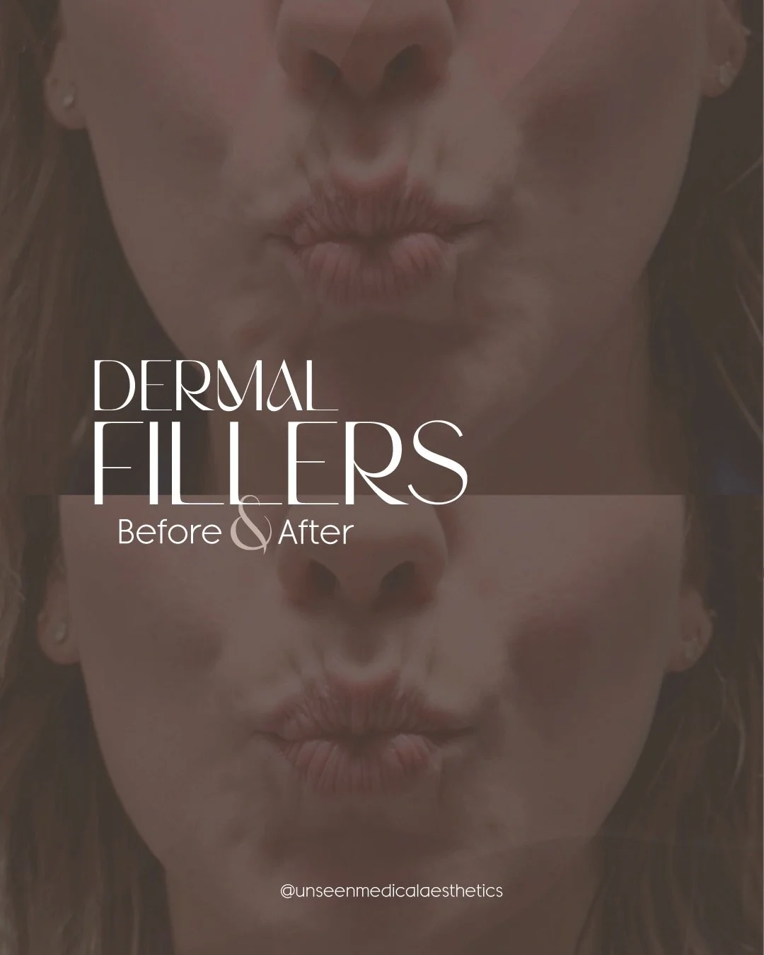 Chin shadows aren&rsquo;t about adding volume.
They&rsquo;re about restoring balance and light through myomodulation.

RHA 3 placed via cannula supports the mentalis and surrounding structures to soften chin shadows and rebalance the lower face&mdash