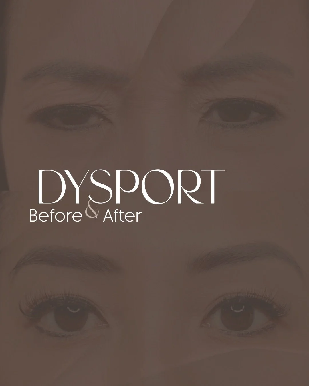 Upper face toxin is about control, not freezing expression.
Strategic treatment of the frontalis, glabella, and orbicularis oculi facial muscles to smooth lines without heaviness.
Results shown at full effect 🤎💉✨🙌🏻
#upperfacetoxin #neuromodulator