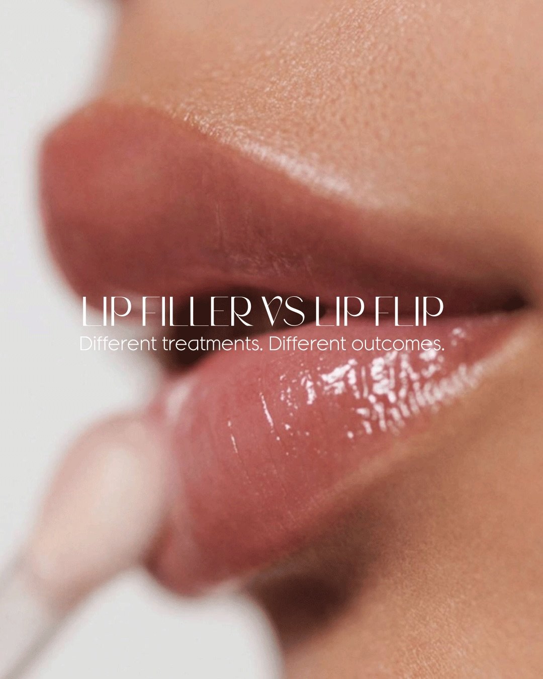 The Unseen Standard 👄🤎✨
No trend-driven lips.
No pressure to use a full syringe.
Treatment based on anatomy, not aesthetics alone. #LipFillerEducation
#LipFlip
#NaturalLipEnhancement
#FacialAesthetics
#westchesterinjector