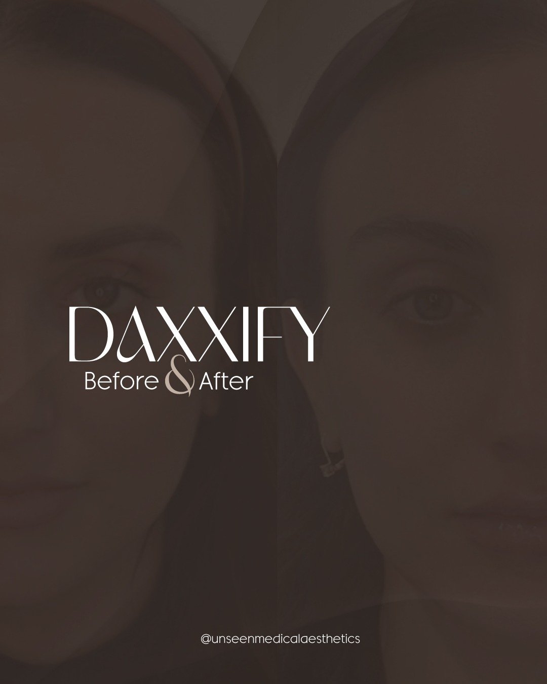 Preventative Daxxify focuses on controlling muscle movement before lines become static. 🤎🙌
This treatment included three upper-face sites, nasal slimming, and chin relaxation to maintain natural expression while reducing excess tension.
Unseen.
*No