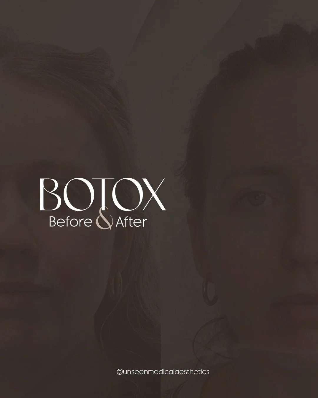 ✨ Sculpt without surgery. ✨
The Nefertiti lift isn&rsquo;t just a trend&mdash;it&rsquo;s precision where it matters: jawline, neck, and subtle facial contouring. Relax, refine, reveal.

Because strong lines age better than harsh lines.

#nefertitilif