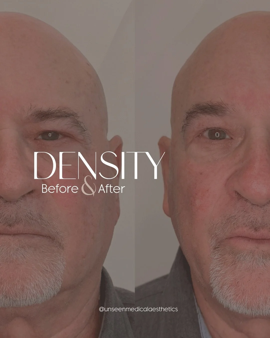 Stronger skin isn&rsquo;t just for prevention &mdash; and it&rsquo;s not just for women.

This male Density RF result shows the immediate tightening we see in the superficial epidermis right after treatment. Think of it as the first visible step in t
