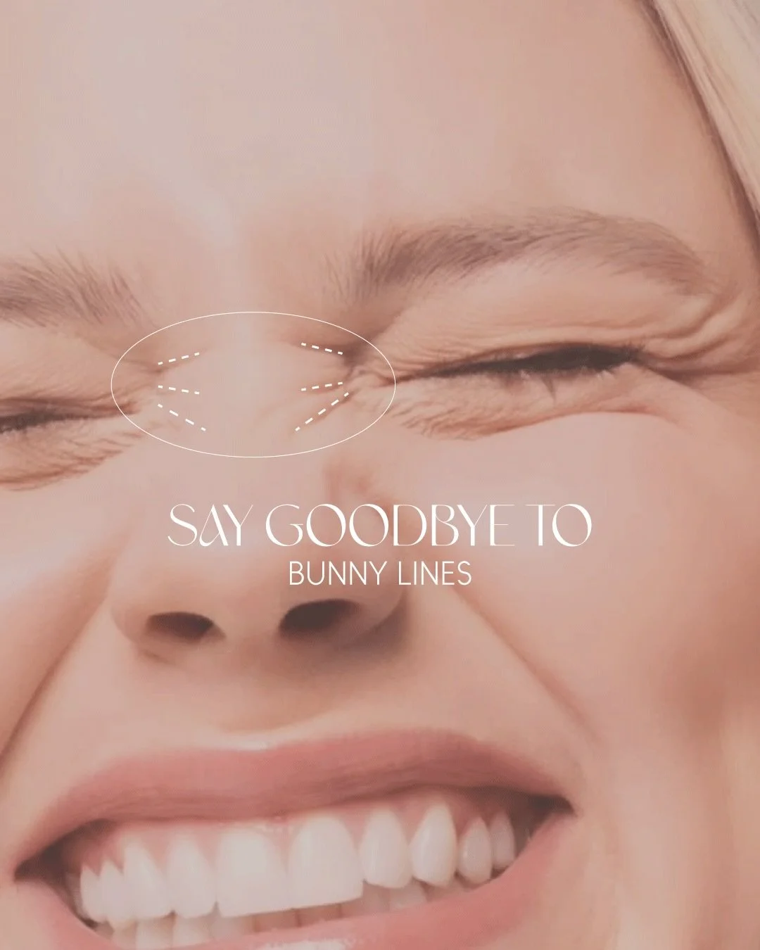 Bunny lines&mdash;those soft lines that appear across the nose when you smile or scrunch&mdash;are a natural part of expression. But when they become more pronounced, they can disrupt facial harmony.

At UNSEEN, we treat this area with precision. Usi