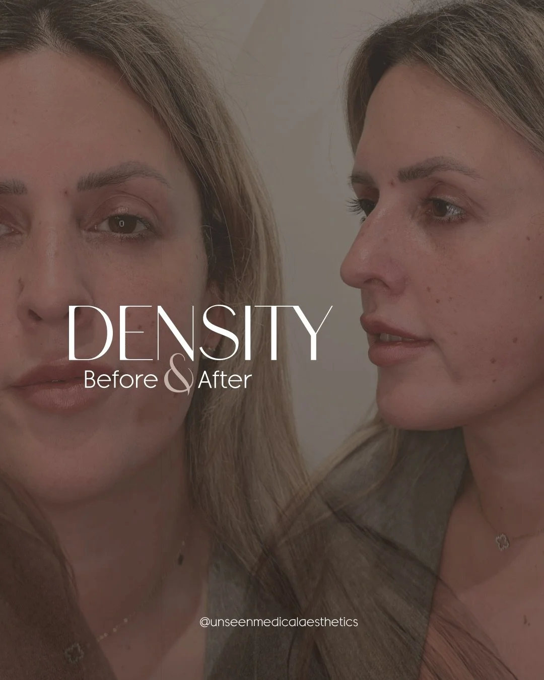 RF energy stimulating collagen where your skin is thinning&mdash;
so you get structure, firmness, and support back over time.

No puff. No overfill. Just better skin. 

Swipe to hear what our patient&rsquo;s say about this treatment! 

DM &ldquo;DENS
