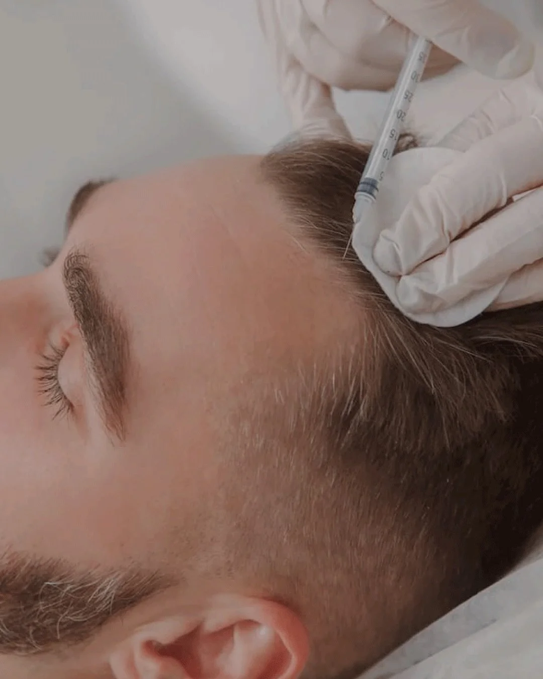 Your blood carries powerful regenerative potential. 🩸✨

Selphyl PRFM hair injections harness concentrated growth factors in a fibrin matrix designed to support healthier follicles, scalp health, and stronger-looking hair over time.

No foreign subst