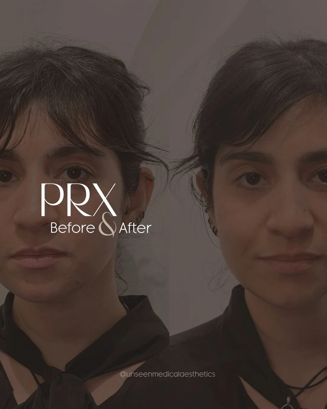 PRX for the skin that looked &ldquo;fine&rdquo;&hellip; until you saw what was possible 🫶🏻

No needles. No peel. Just tighter, brighter, healthier-looking skin. 

Swipe to see how the treatment is performed and for an amazing before + after.

Safe 