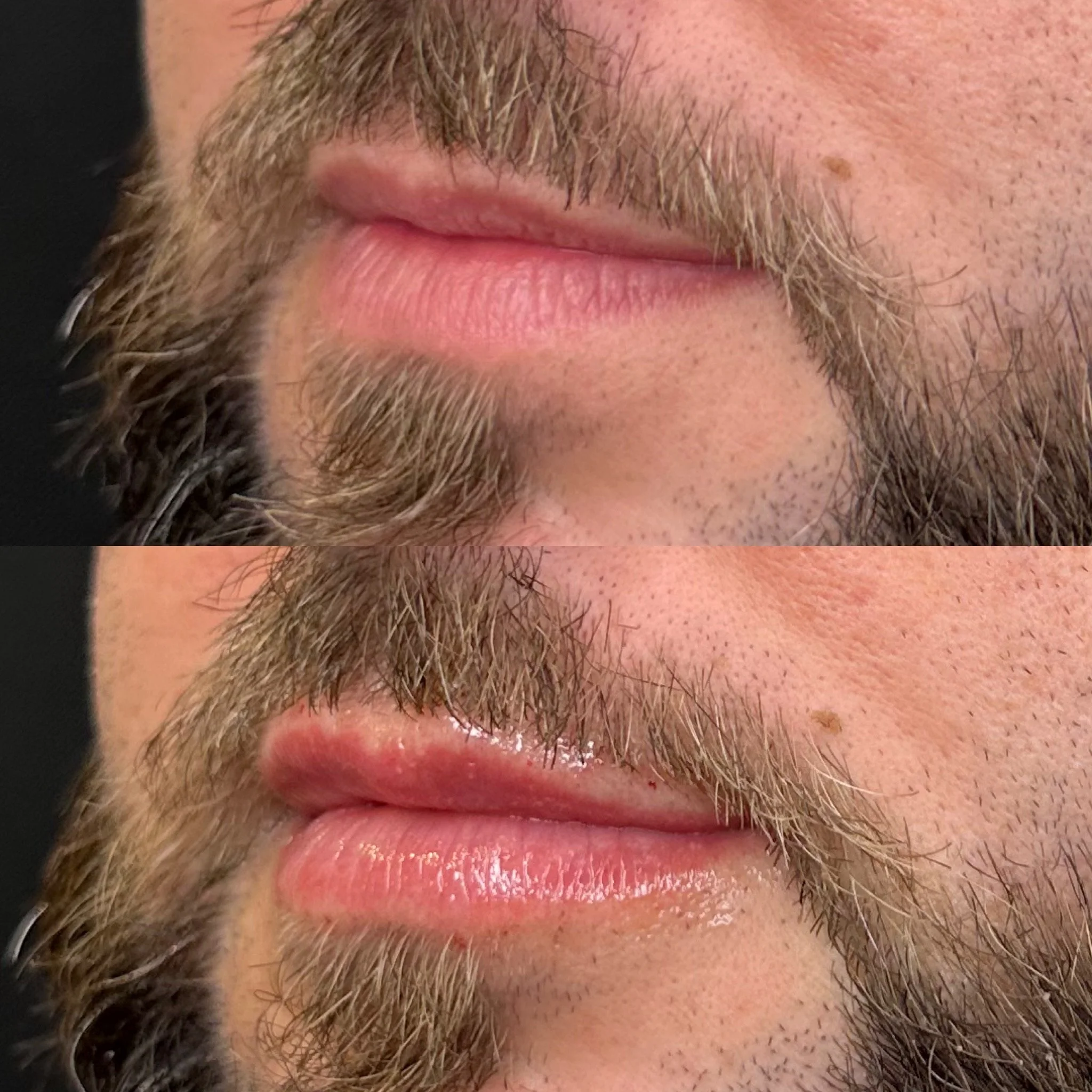 Close-up of a person's mouth, beard, and mustache with a lightly freckled skin and some facial hair visible.