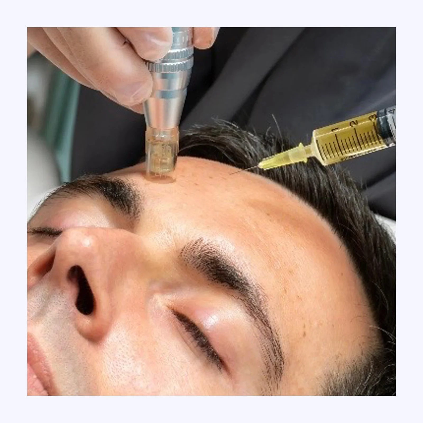 A person receiving a cosmetic injection on the forehead with a syringe, while lying down with closed eyes.