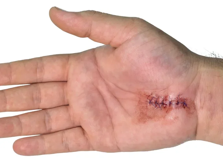 Close-up of a human hand with a stitched wound on the palm.