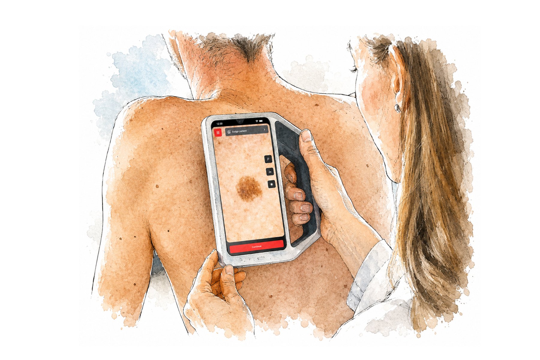 Illustration of a clinician performing digital mole mapping on a patient’s back