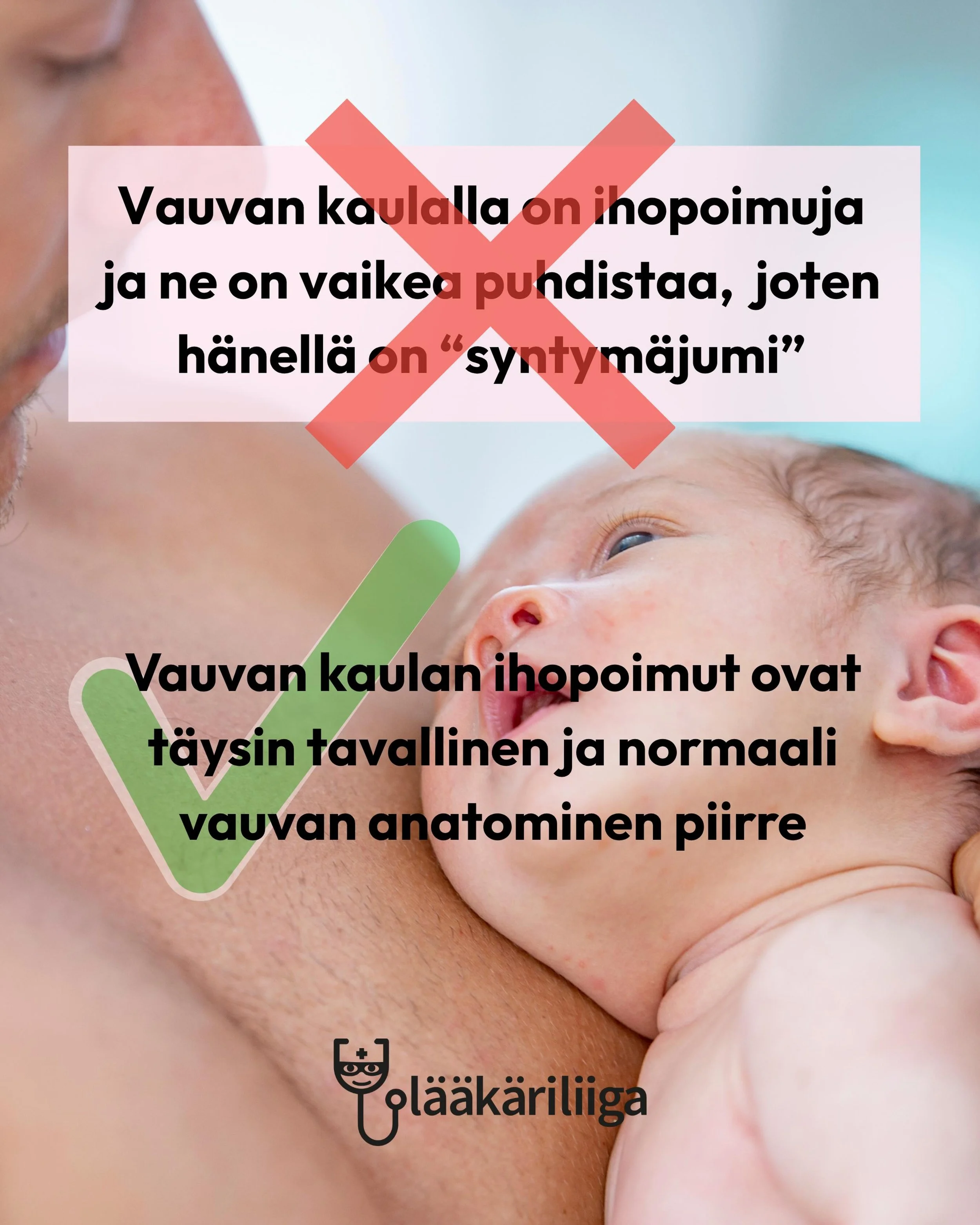 Vauvojen kaulan ihopoimuihin kertyy helposti kosteutta ja likaa. T&auml;m&auml;n vuoksi iho voi joskus hautua, punoittaa ja &auml;rty&auml;.

Kyse on kuitenkin tavallisesta vauvan anatomiasta, ei &ldquo;syntym&auml;jumista&rdquo;, johon tarvitsisi os