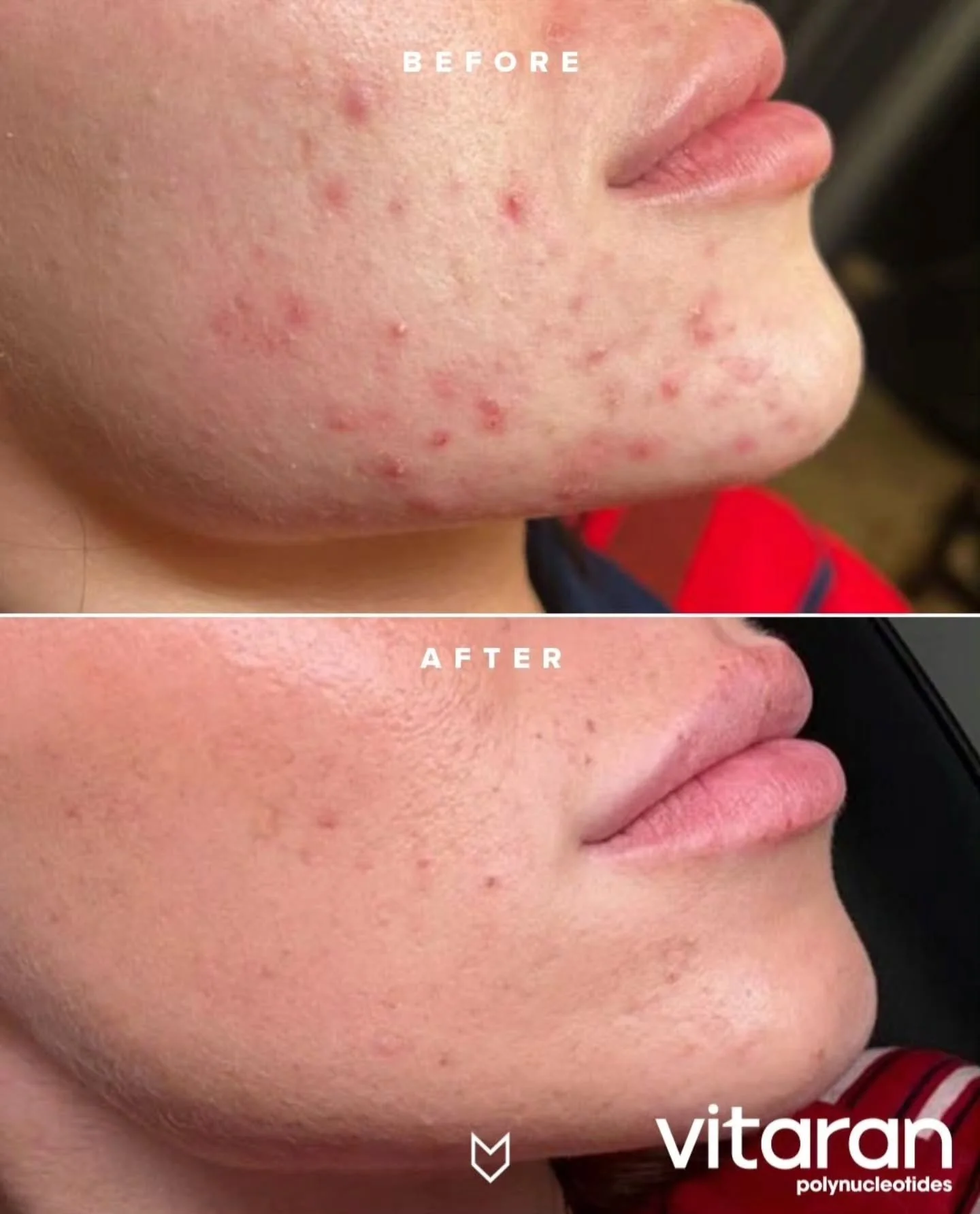 🧬 Polynucleotides: Your Skin's Natural Reset Button! ✨

Polynucleotides are advanced, injectable bio-stimulators that work deep within your skin to promote repair and regeneration. They are a game-changer for long term skin health!

How They Work:
P