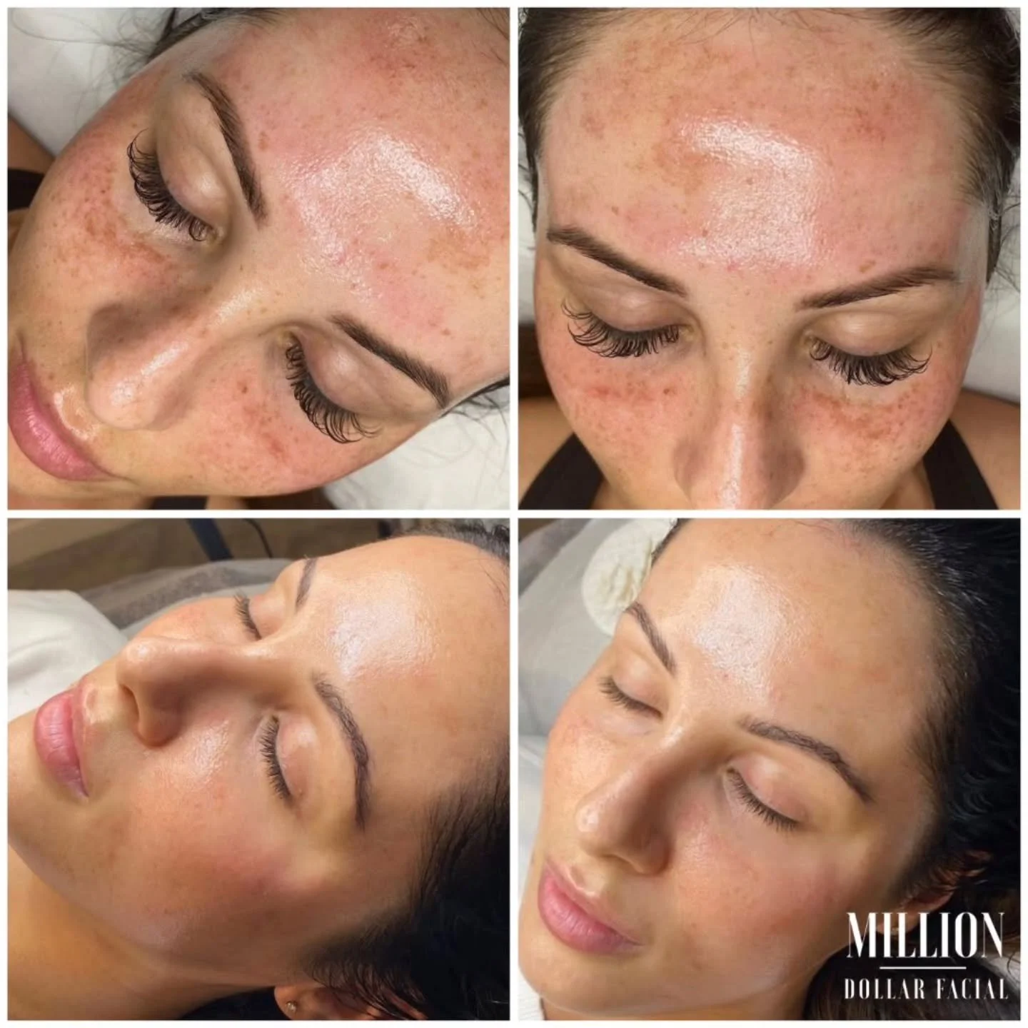 Pigmentation doesn&rsquo;t happen overnight, and it certainly doesn&rsquo;t fade overnight 💆🏼&zwj;♀️

This transformation is the result of a targeted routine focusing on tyrosinase inhibitors and consistent sun protection ☀️

By slowing down the ov