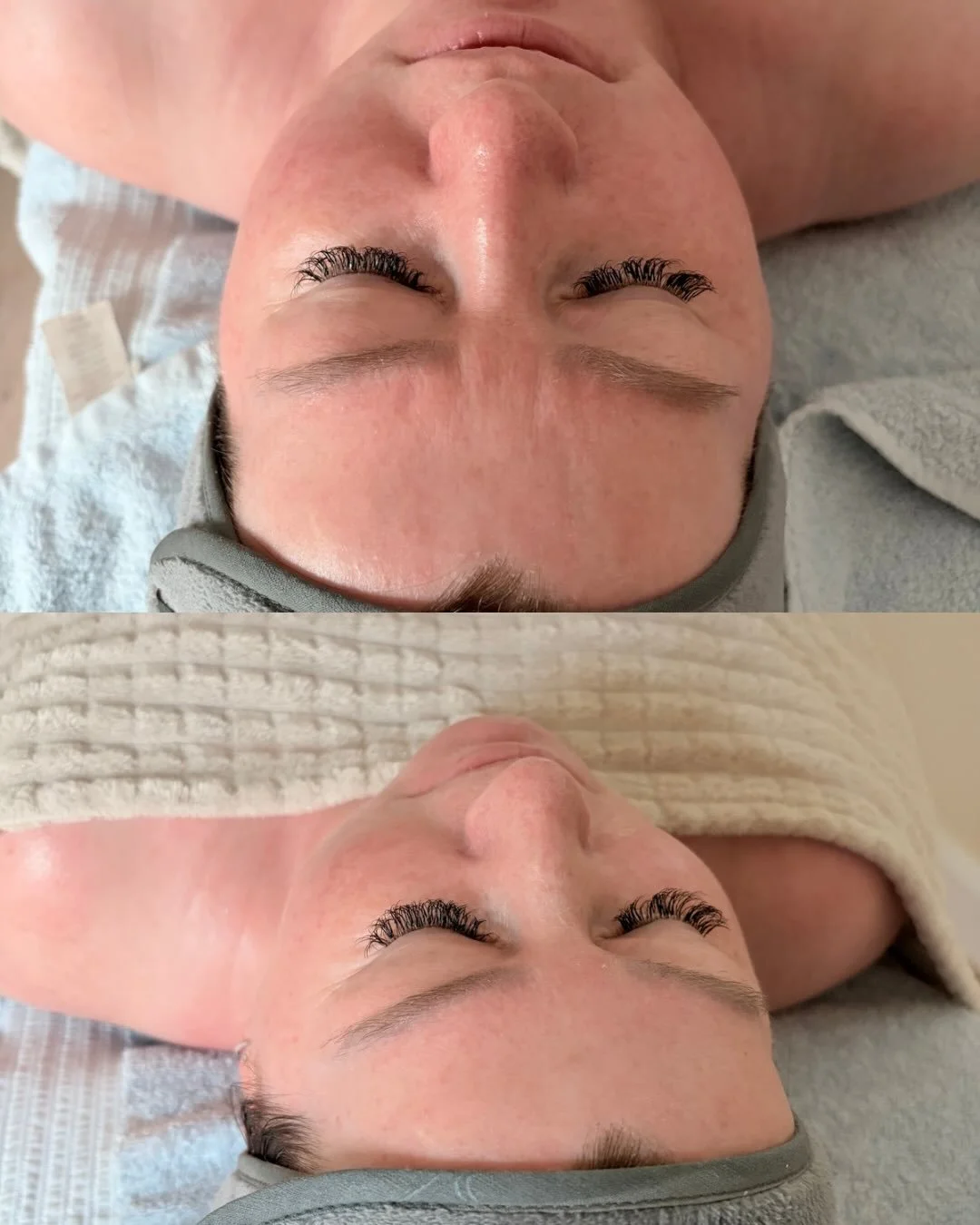 Amazing results straight after just one facial 🙌🏻✨

Redness visibly reduced, skin clearer, brighter and overall more relaxed with a healthy glow ✨

This was straight after a fully tailored Environ facial, using their advanced technology to drive ac