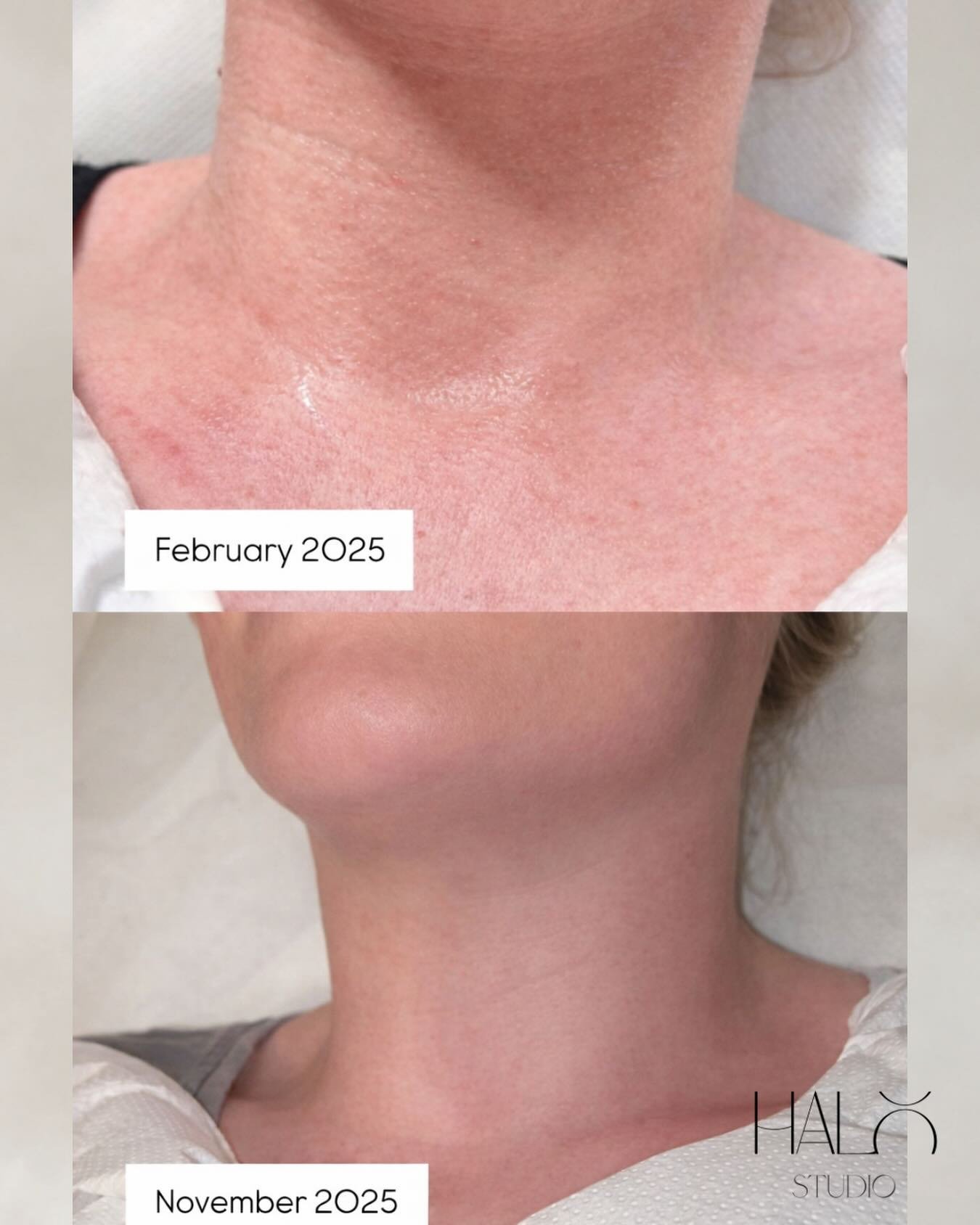 This is what consistency looks like 🔥

Client wanted to treat texture and fine lines on her neck. 

We started Halo Signature Body Microneedling, and she came consistently over the course of 10 months while following all recommended home and after c