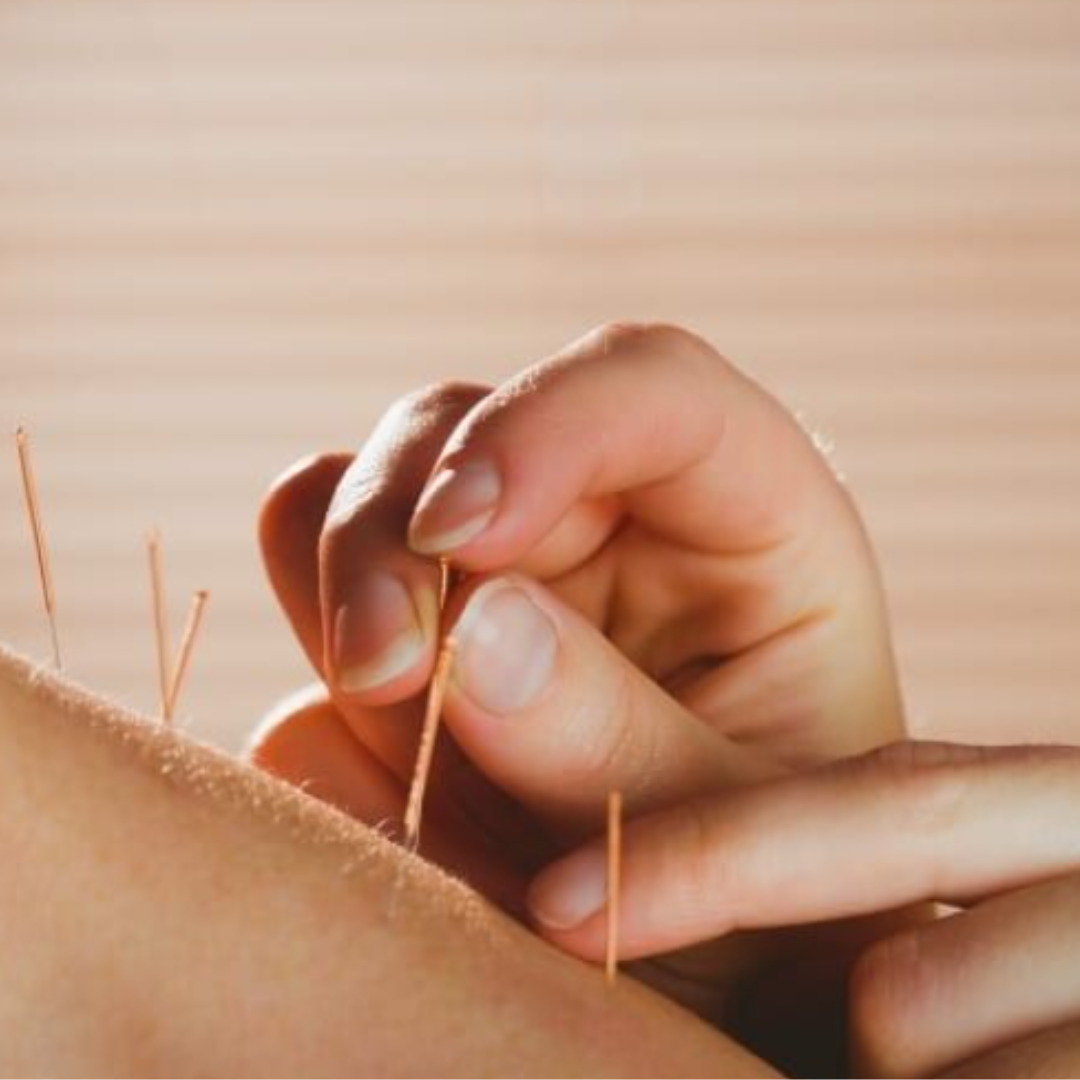 A person is performing acupuncture on a person's back, inserting thin needles into specific points.