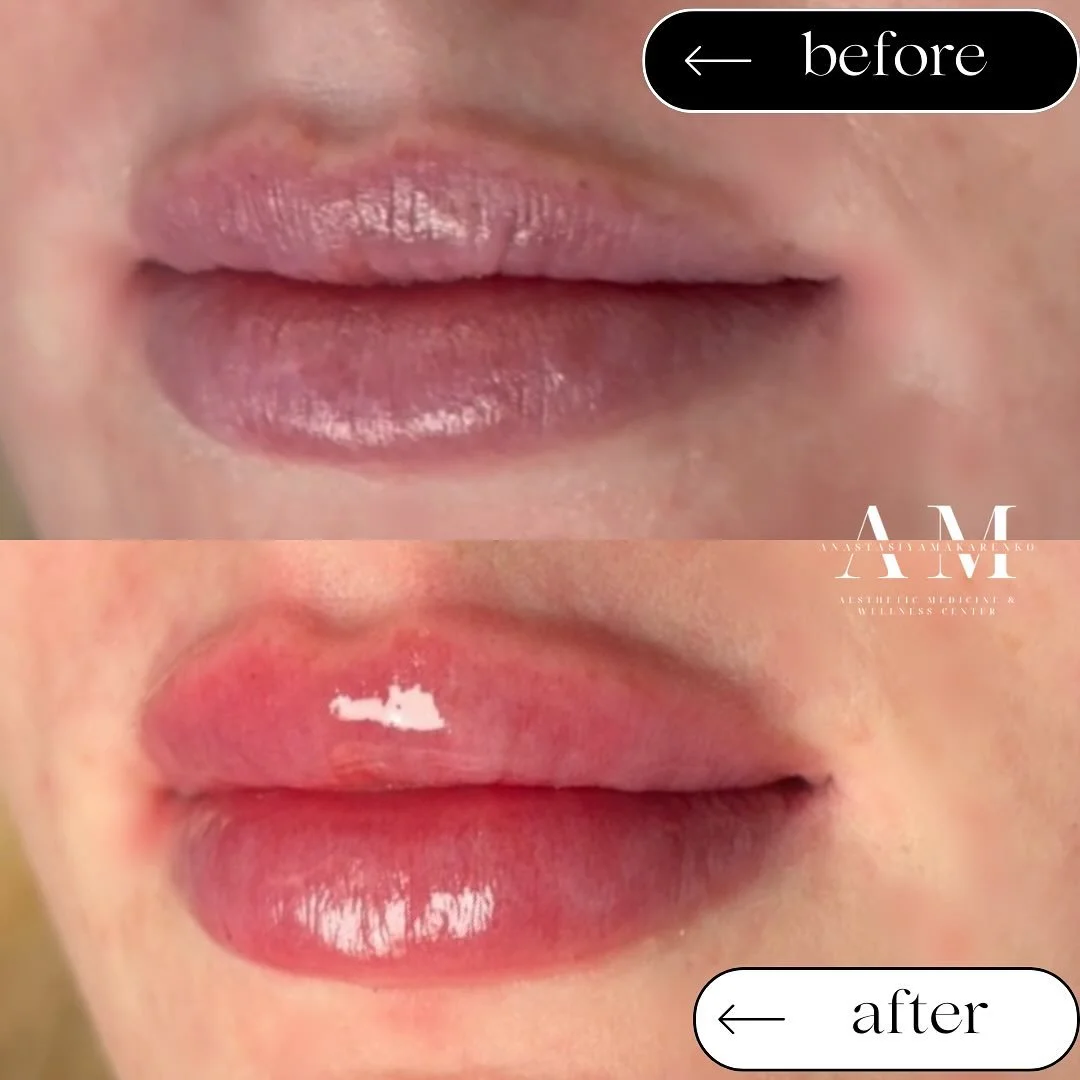 Keep your pout plump &amp; hydrated!💋

A subtle filler refresh every year helps maintain that shape and fullness you love✨💉 

#LipFillerRefresh #PlumpPout #BookNow #Filler #Refresh #BeforeandAfter #Hydrated #Volume #MediSpa